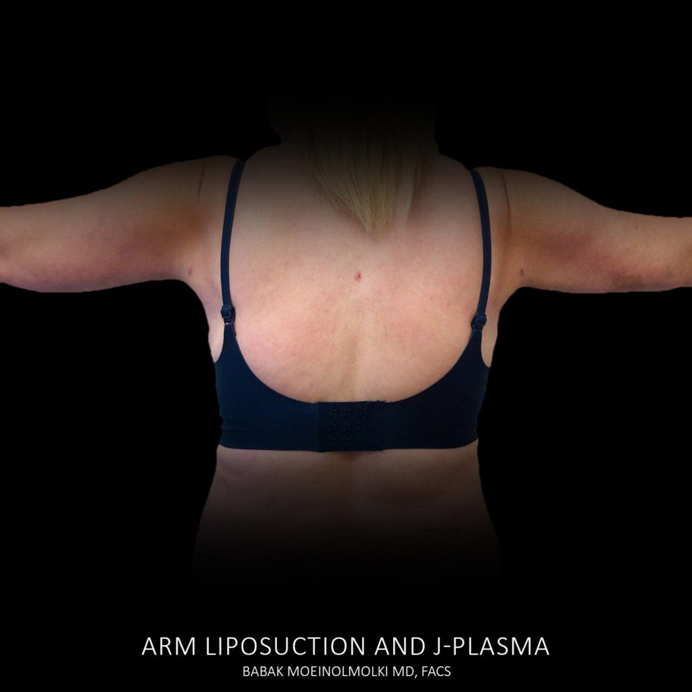 After Arm