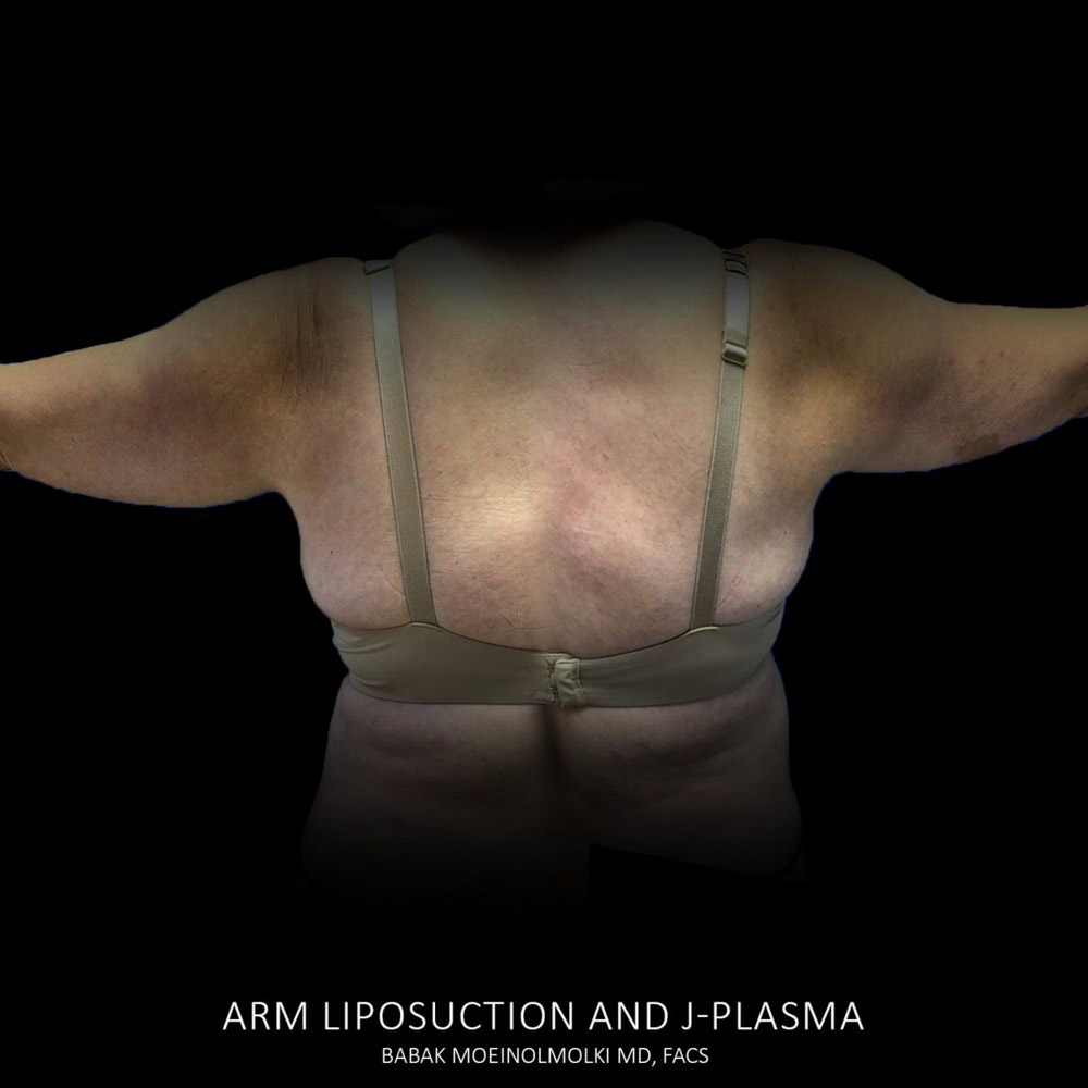 before arm