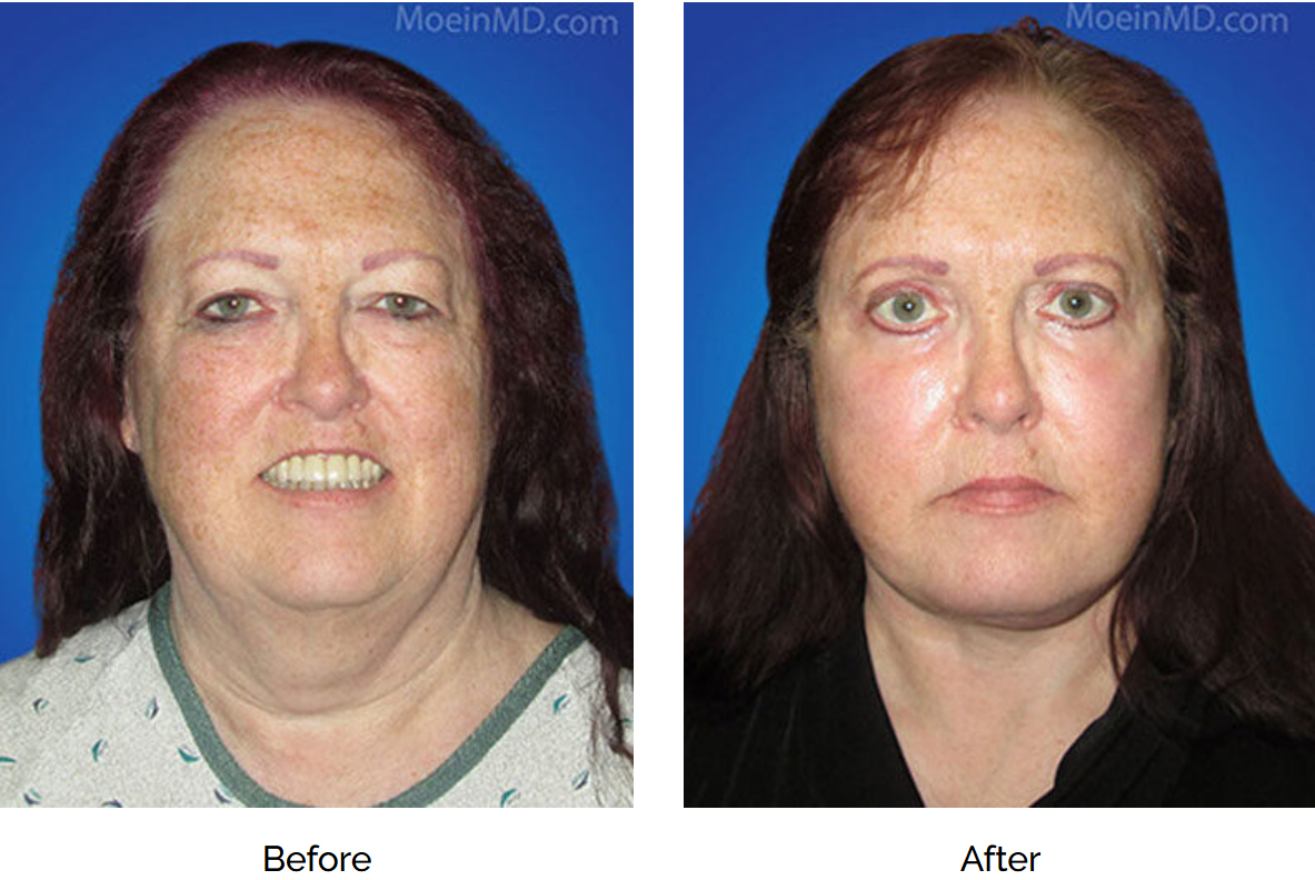 best face lift surgeon