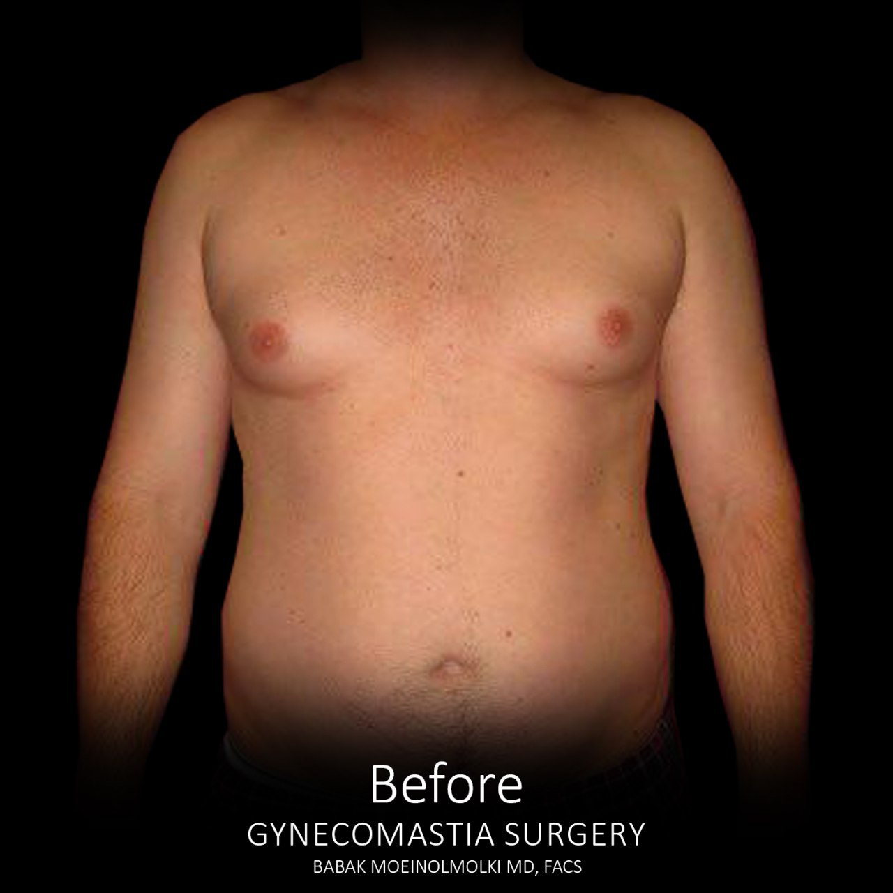 male breast removal before