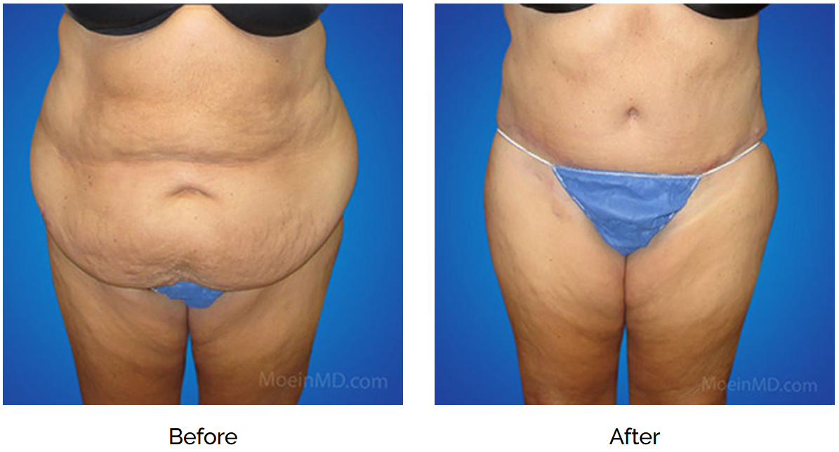 dr. moein liposuction patient before and after midsection