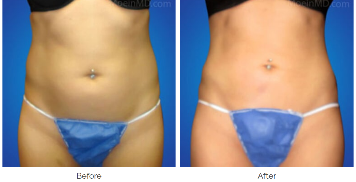 dr. moein liposuction patient before and after midsection