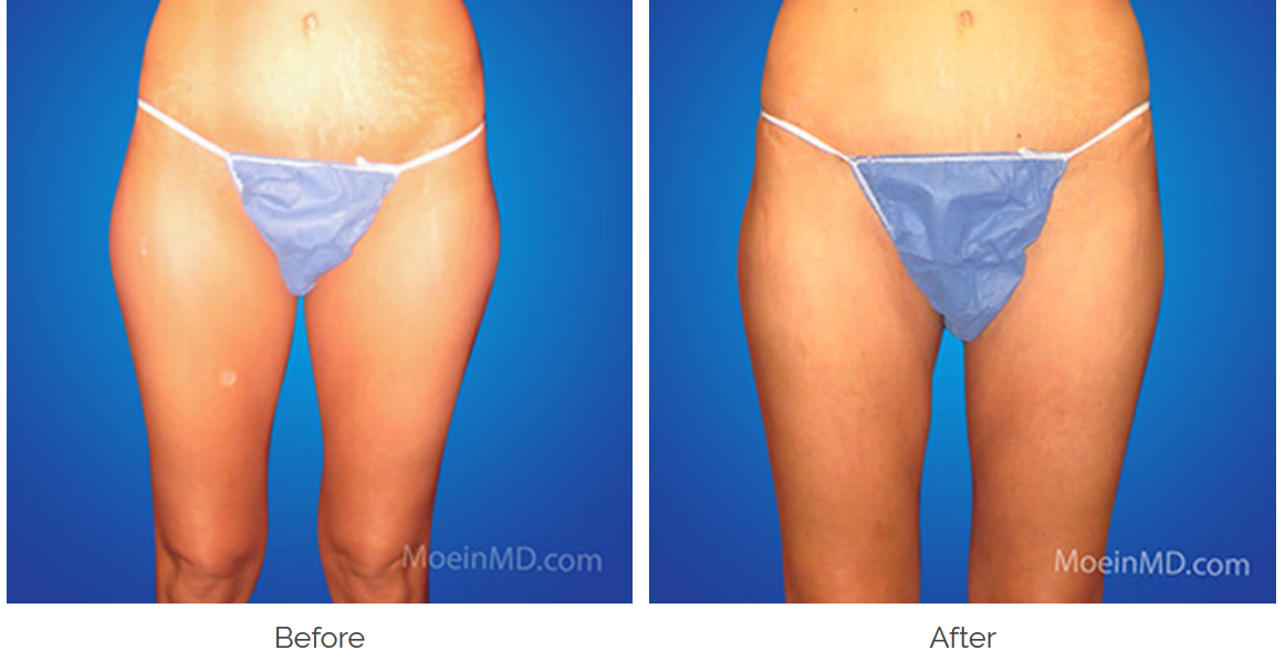 dr. moein liposuction patient before and after lower half