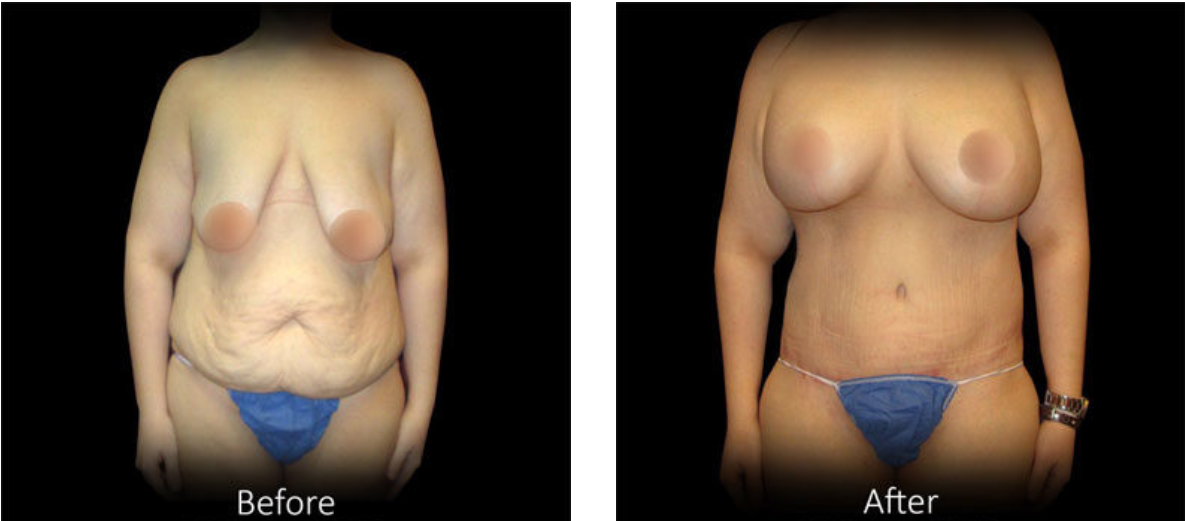 best tummy tuck doctor in los angeles