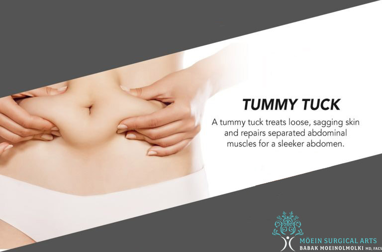  Tummy Tuck for Stubborn Belly Fat and Stretch Marks