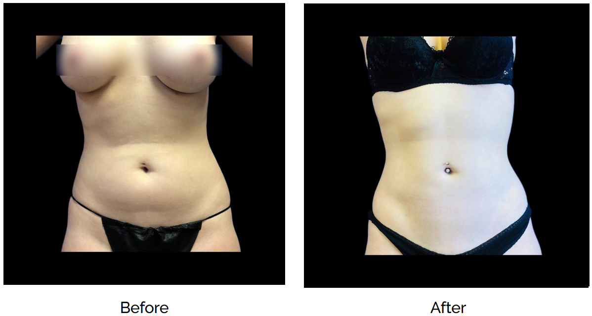 Hi Def Lipo Ab Sculpting