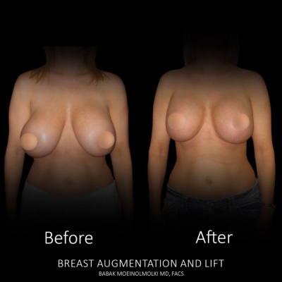 BREAST AUGMENTATION and LIFT