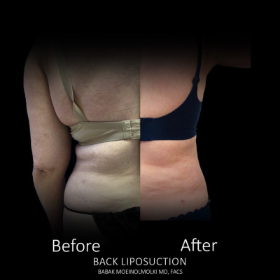 Liposuction Before and After