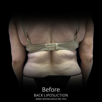 Vaser Liposuction of back waist flank