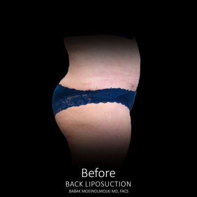Liposuction result