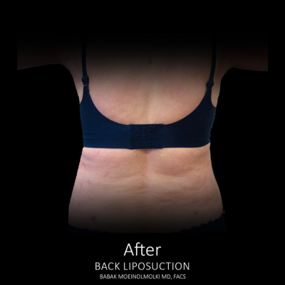 Liposuction After