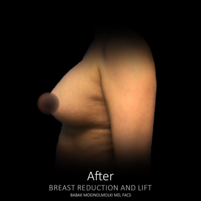 after breast lift and augmentation with fat transfer