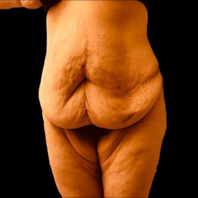 Before Tummy Tuck Liposuction