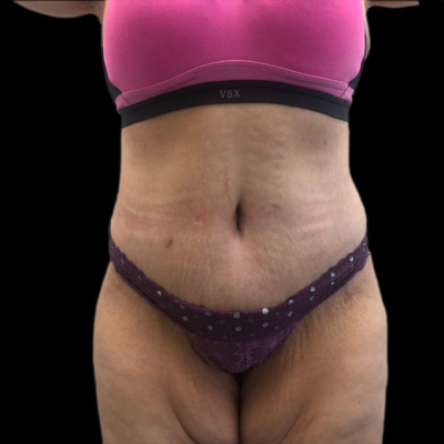 After Extended Tummy tuck and liposuction of waist and flank