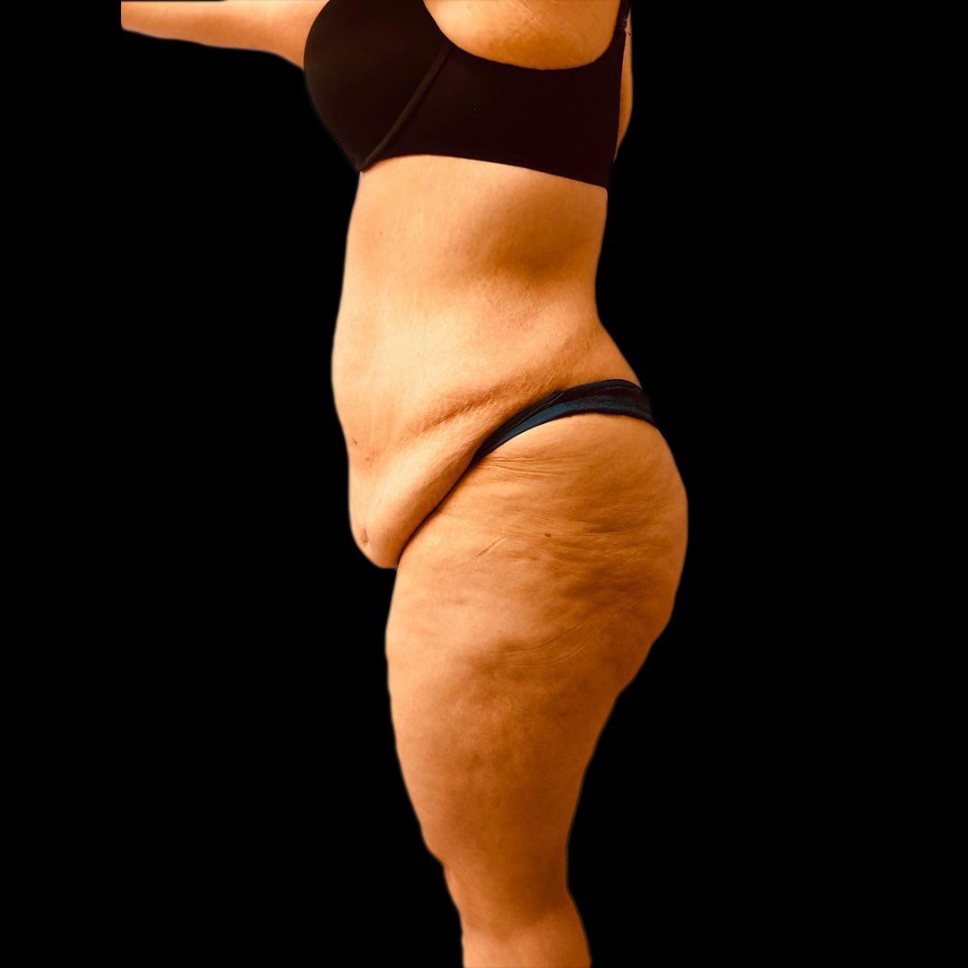 best tummy tuck surgeon