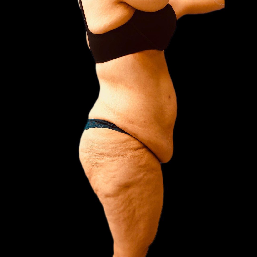 best tummy tuck doctor in los angeles