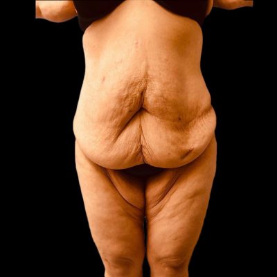 Before Extended Tummy tuck and liposuction of waist and flank