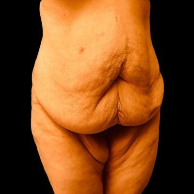 best tummy tuck doctor in los angeles