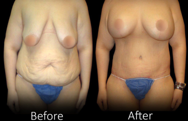 best tummy tuck surgeon