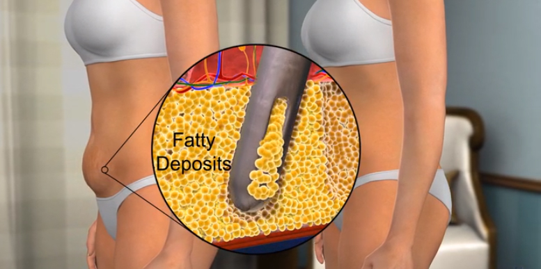 Tummy Tuck Vs Lipo Which Is Best For Body Contouring Health In Los Angeles Ca