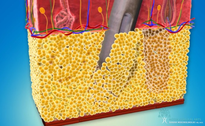 Liposuction surgery