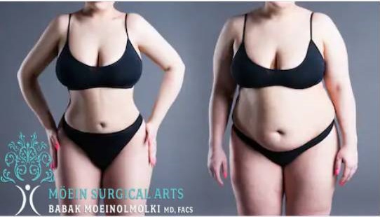 how to reduce belly fat by operation