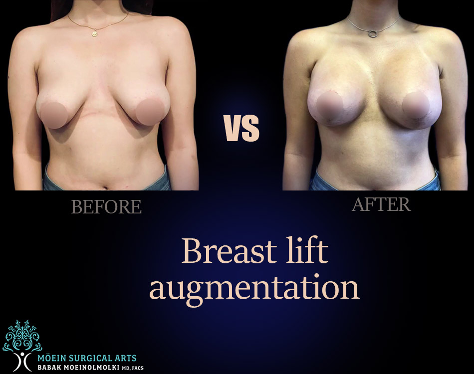 Breast augmentation result
