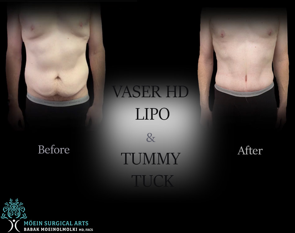 Before & after HD lipo