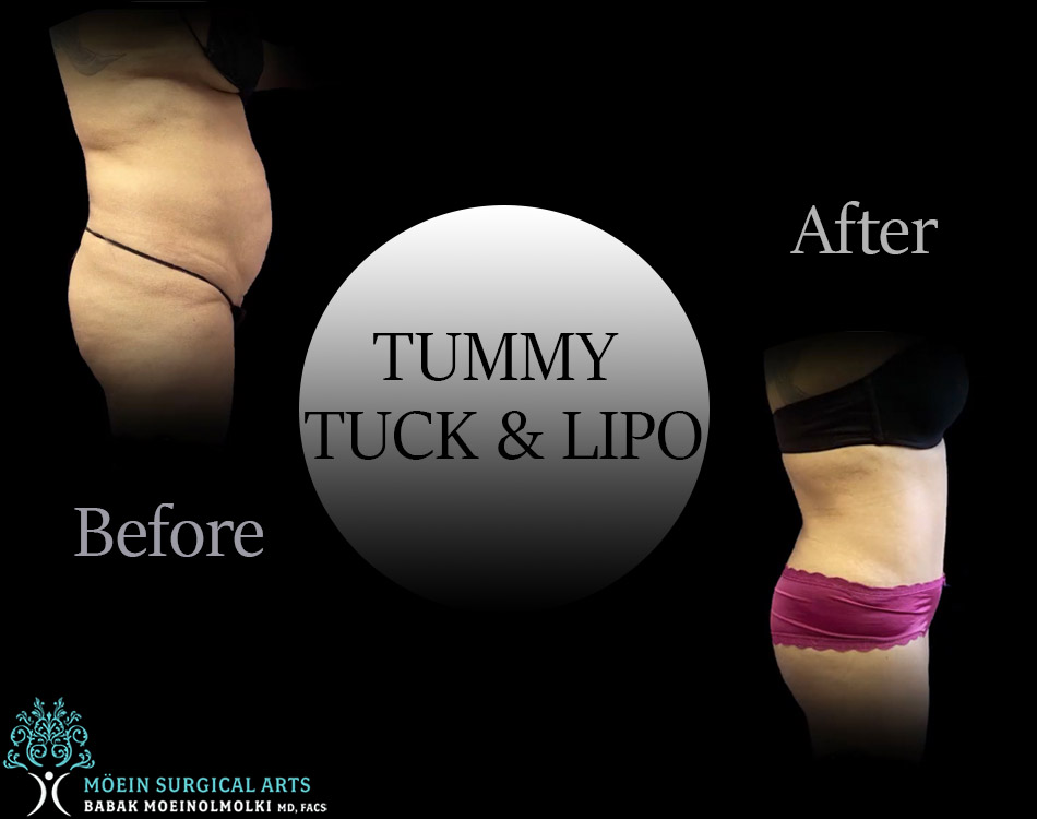 TUMMY TUCK and Lipo Result