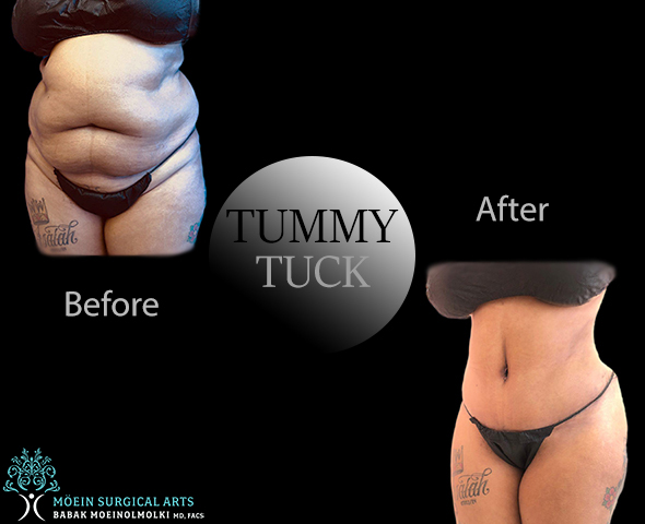 Tummy Tuck Result