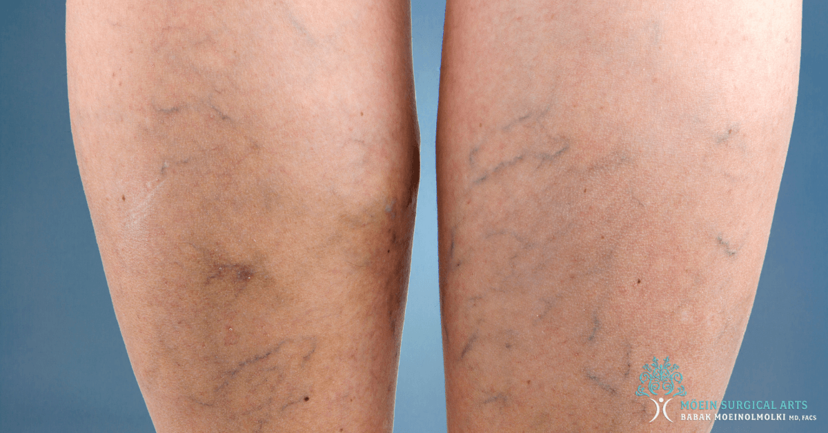 Spider & Varicose Cosmetic Surgery Treatments in Los Angeles CA