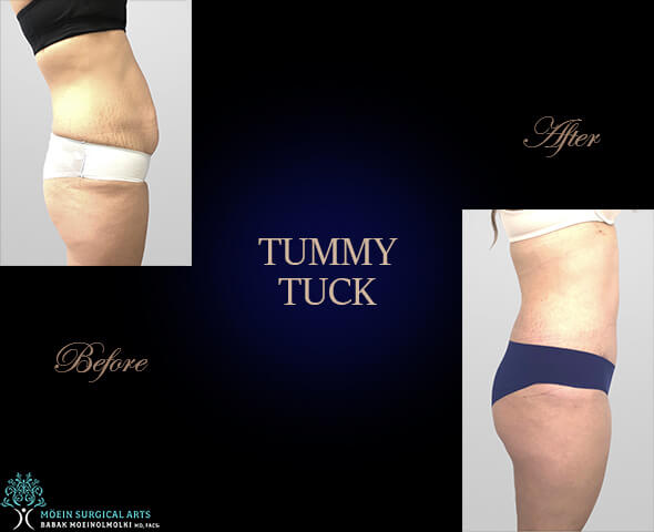 Tummy tuck- Los Angeles