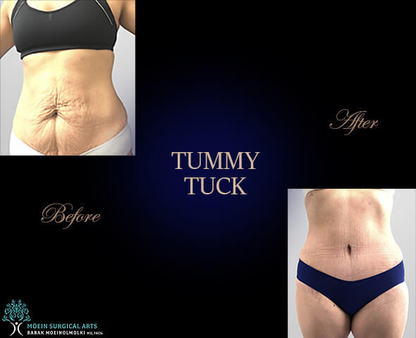 Tummy tuck Surgery in Los Angeles CA