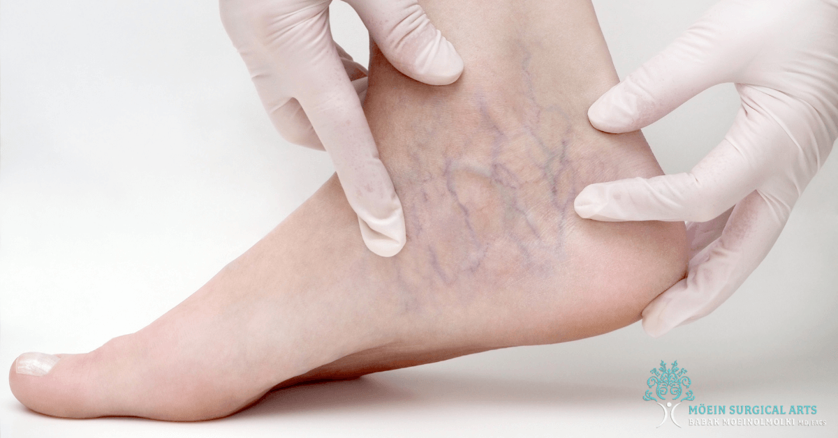Spider veins in Los Angeles CA 
