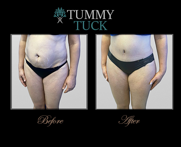 best tummy tuck surgeon