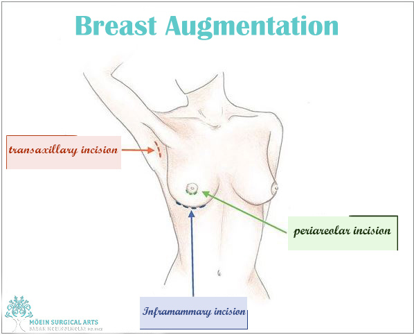 Breast Augmentation-Los Angeles
