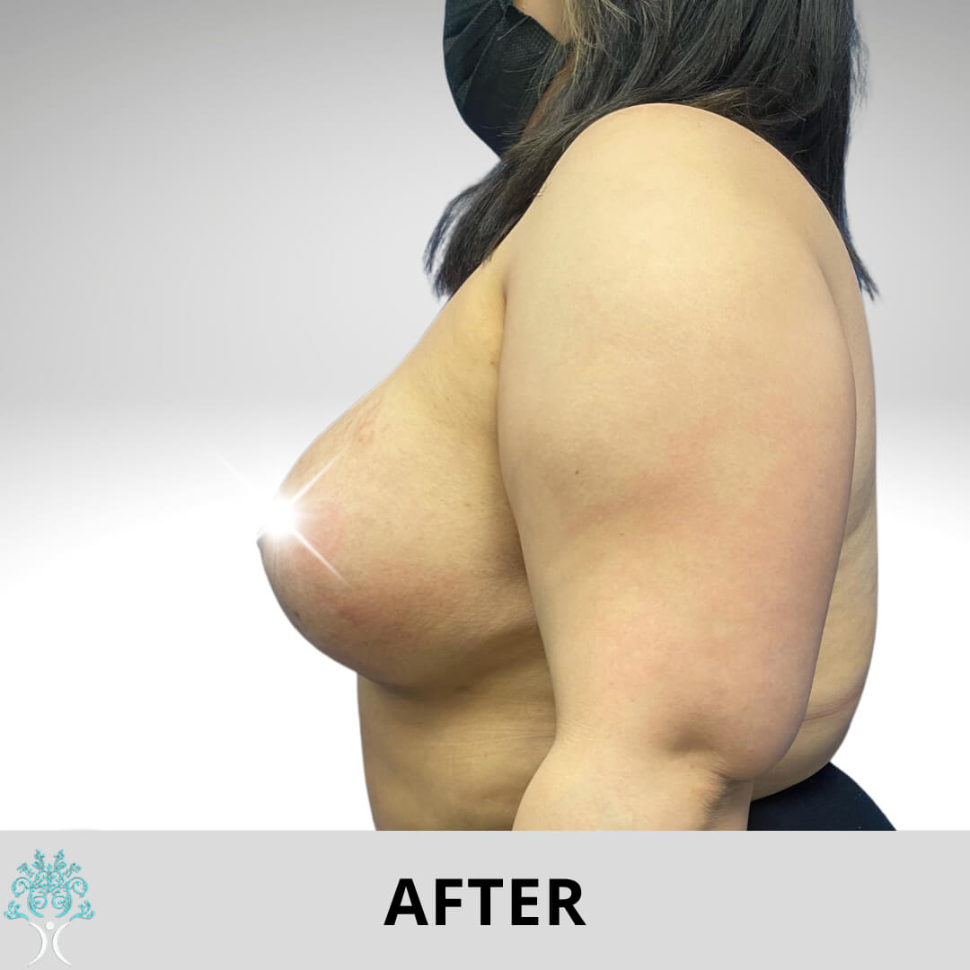 After Augmentation surgery