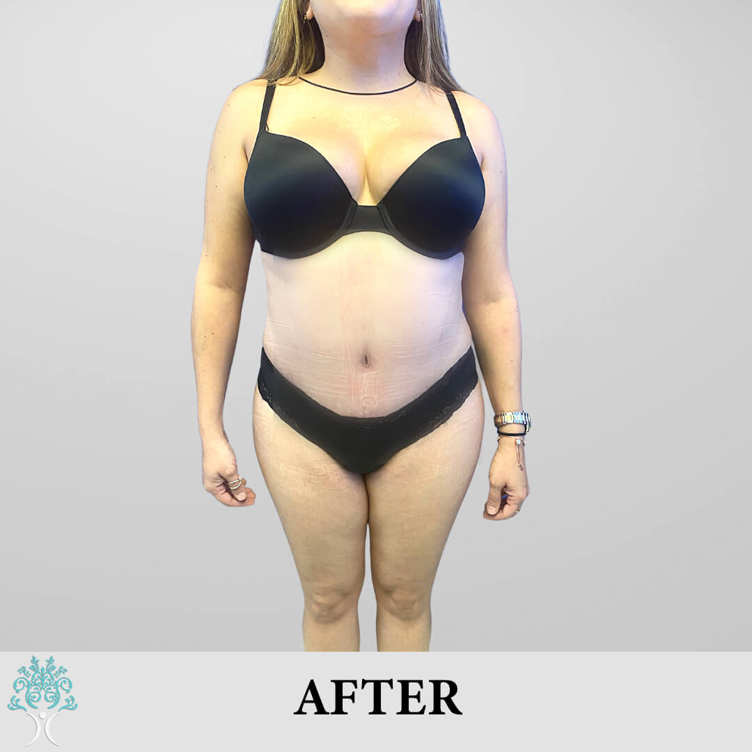 After Lipo & Tummy Tuck