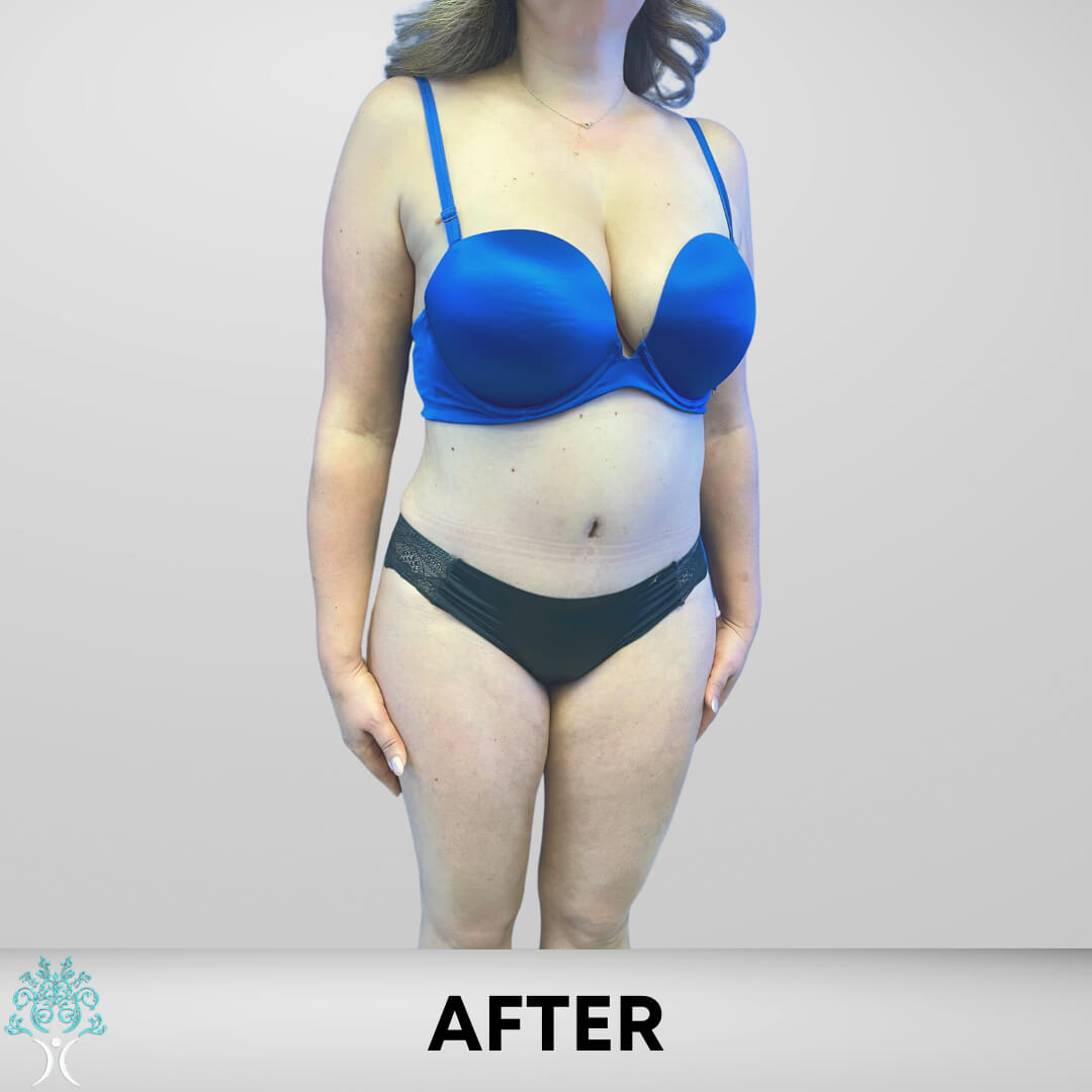 After Lipo and Tummy Tuck