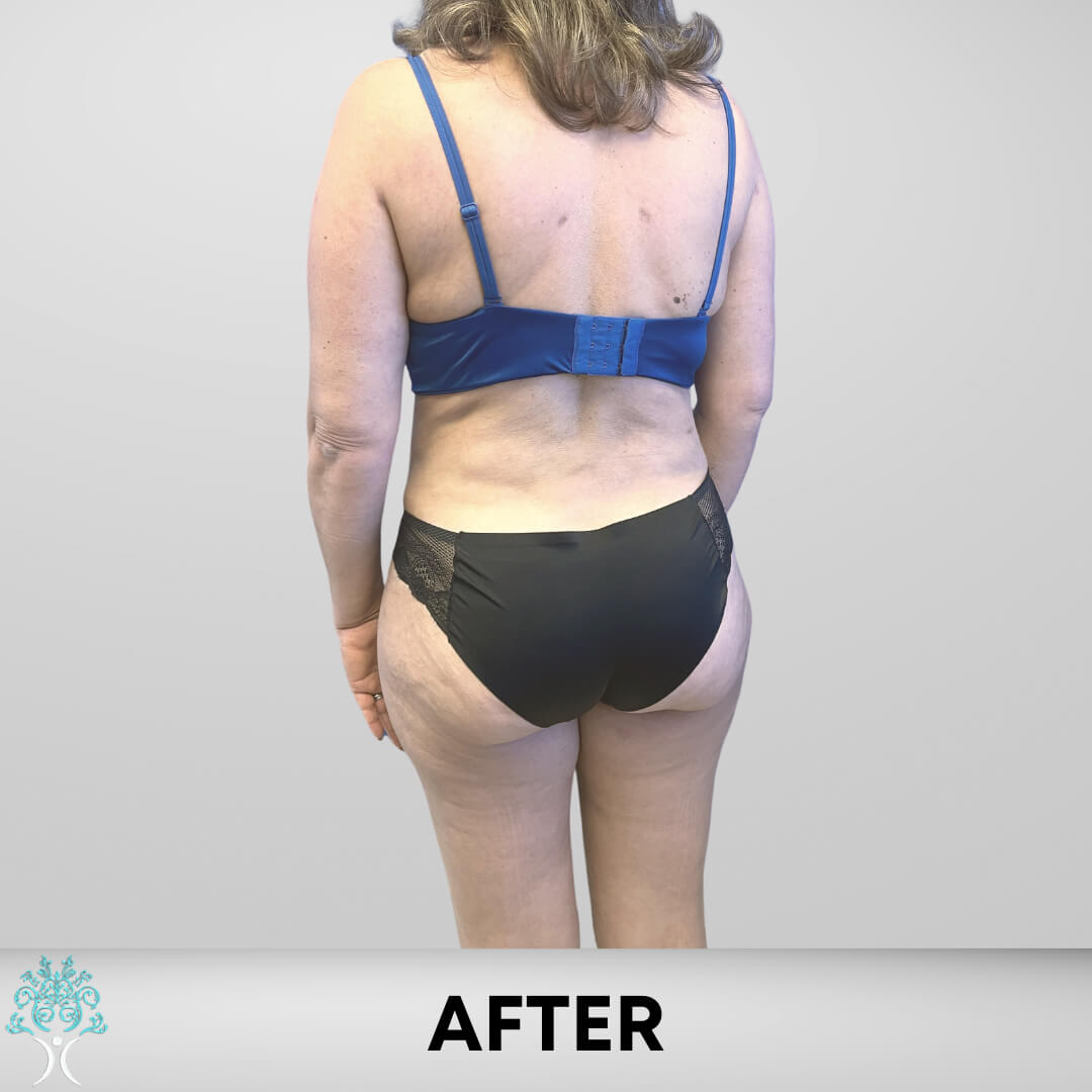 After Tummy Tuck