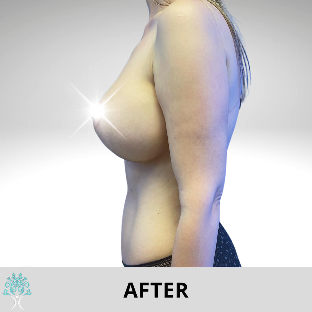 After breast lifte