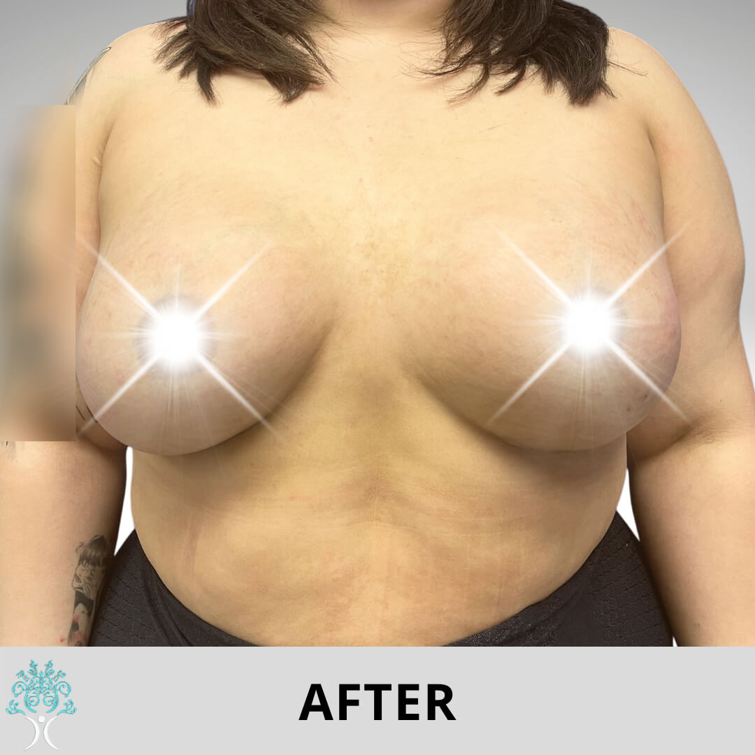 Augmentation after