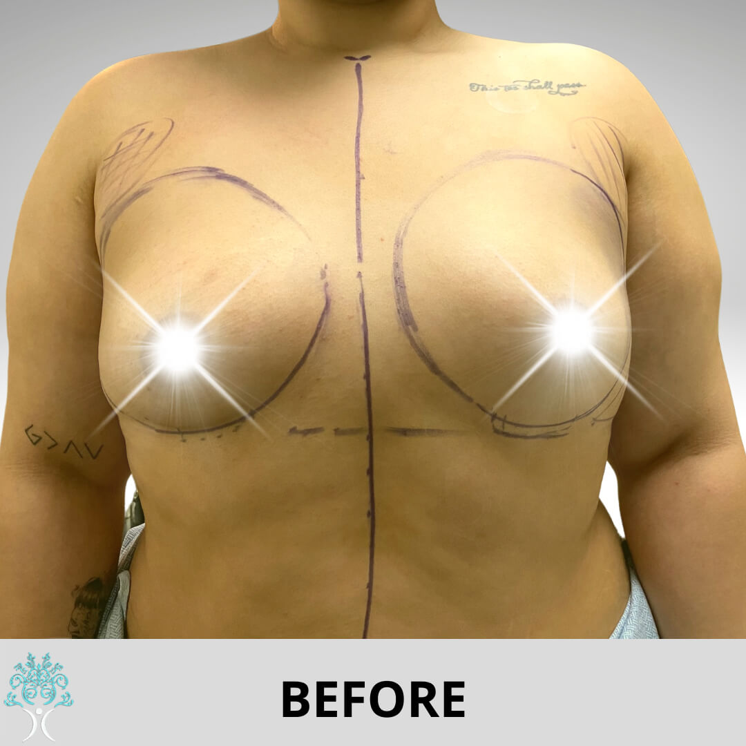 Augmentation before