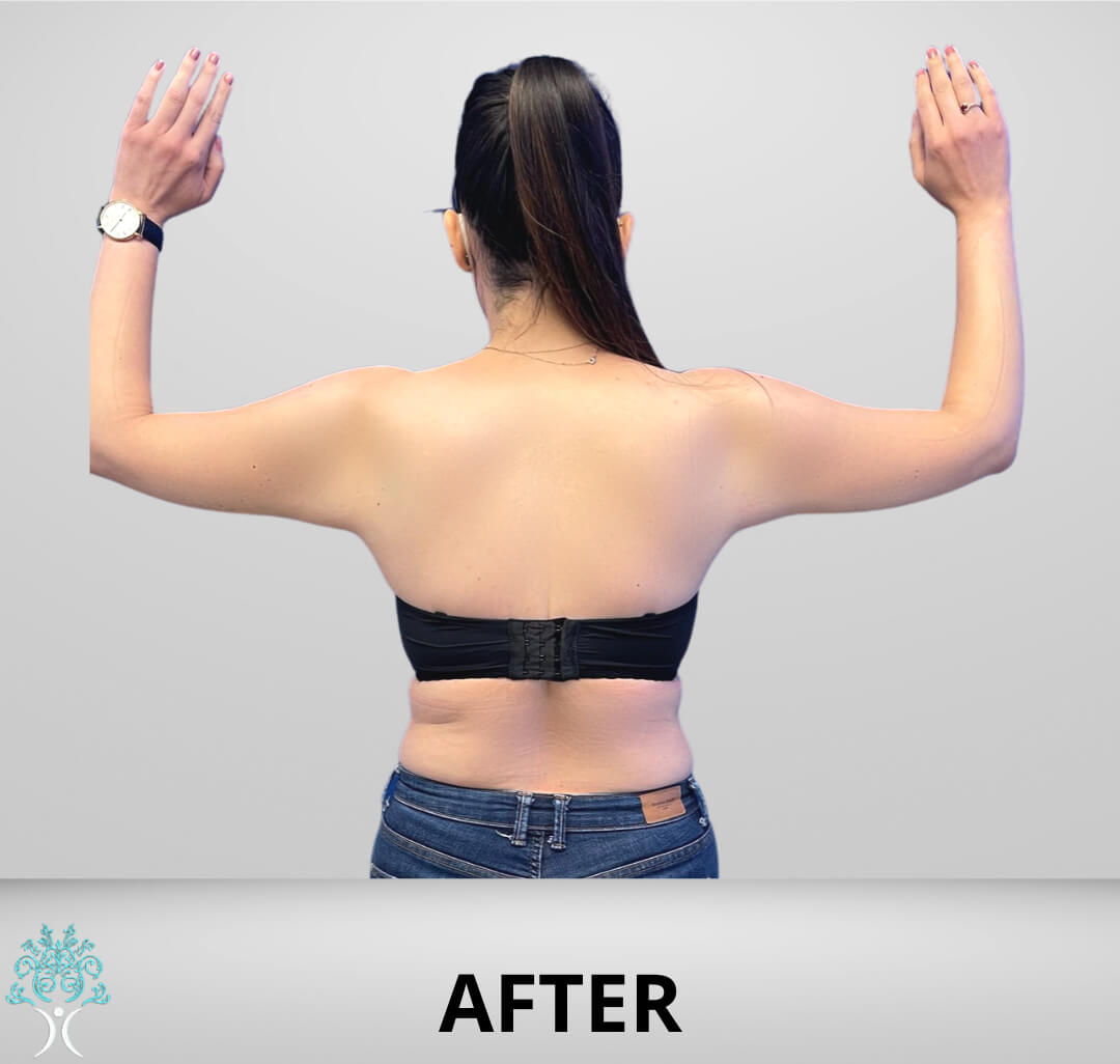 Arm lift after