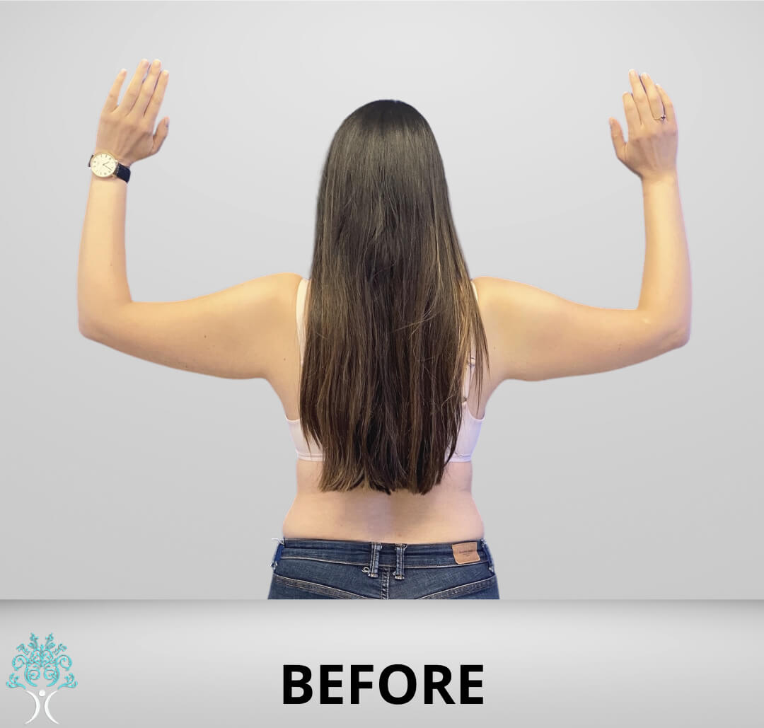 Arm lift before
