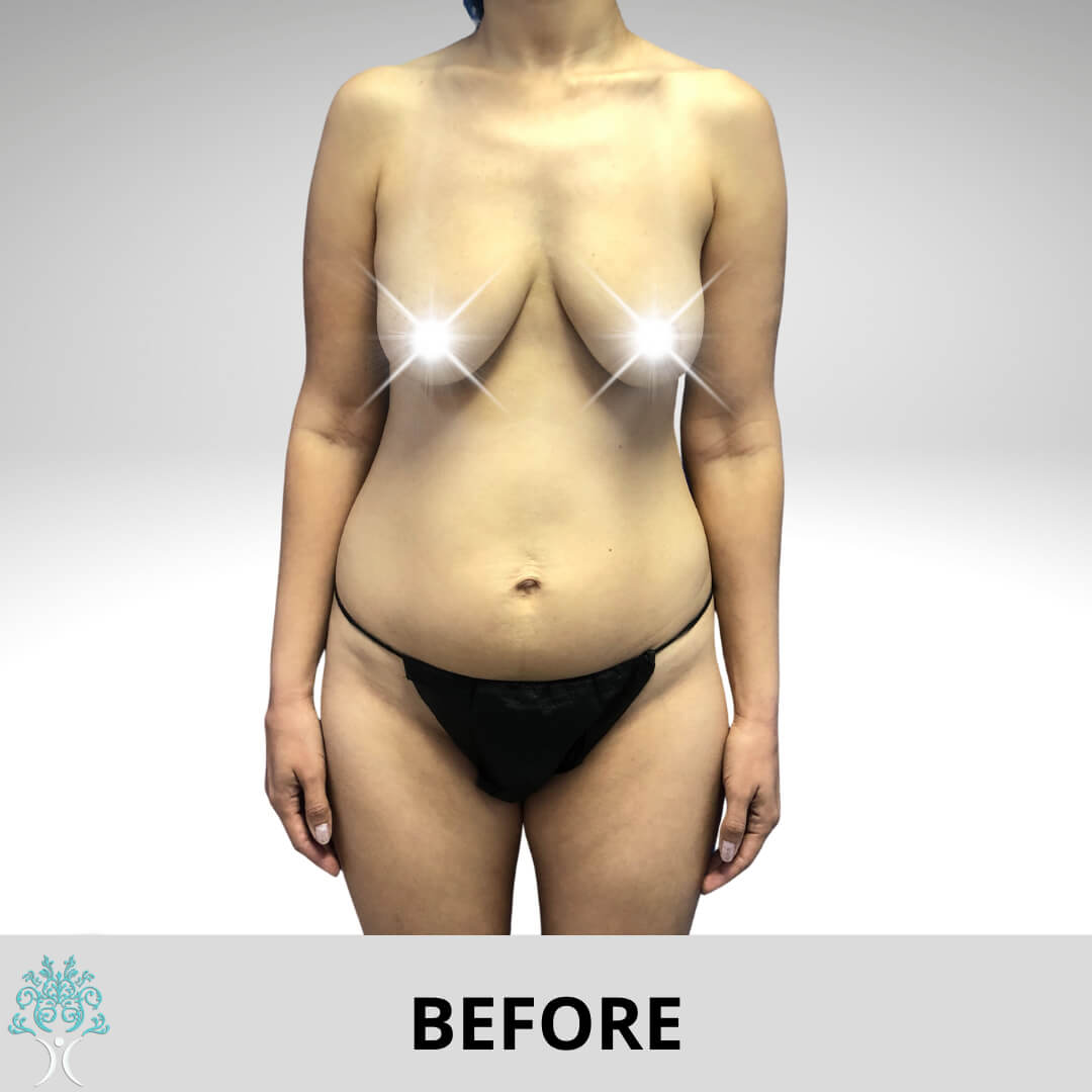 Breast lift Before
