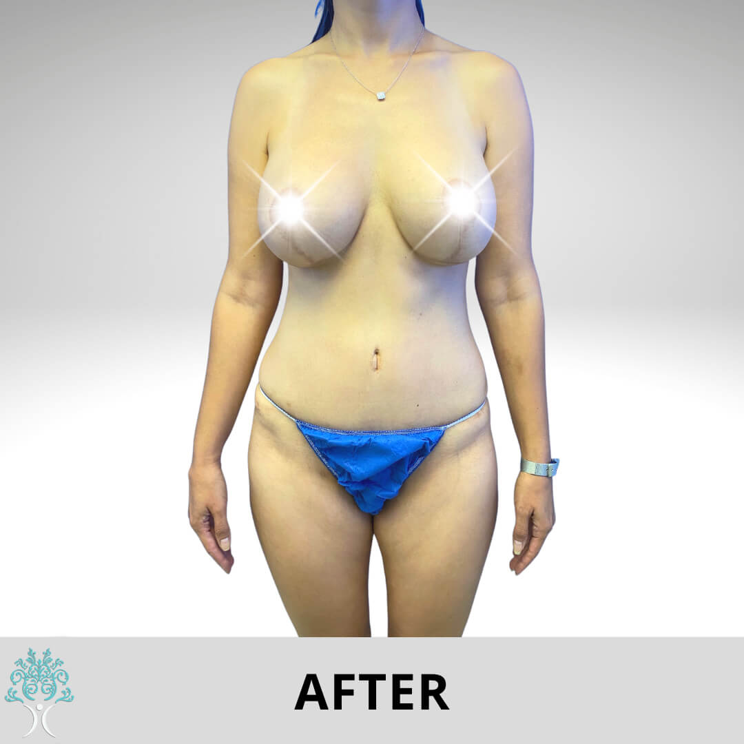 Breast lift after