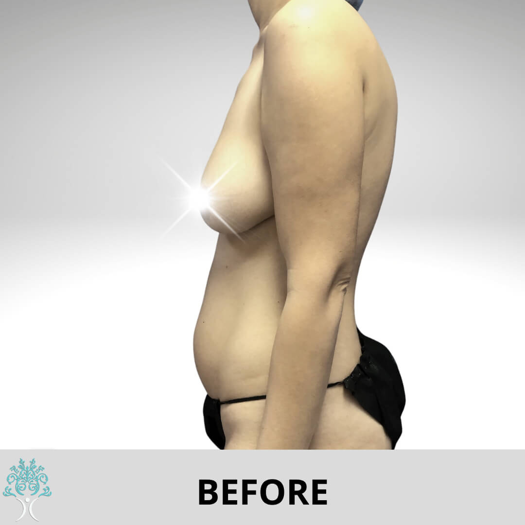 Before Breast Lift