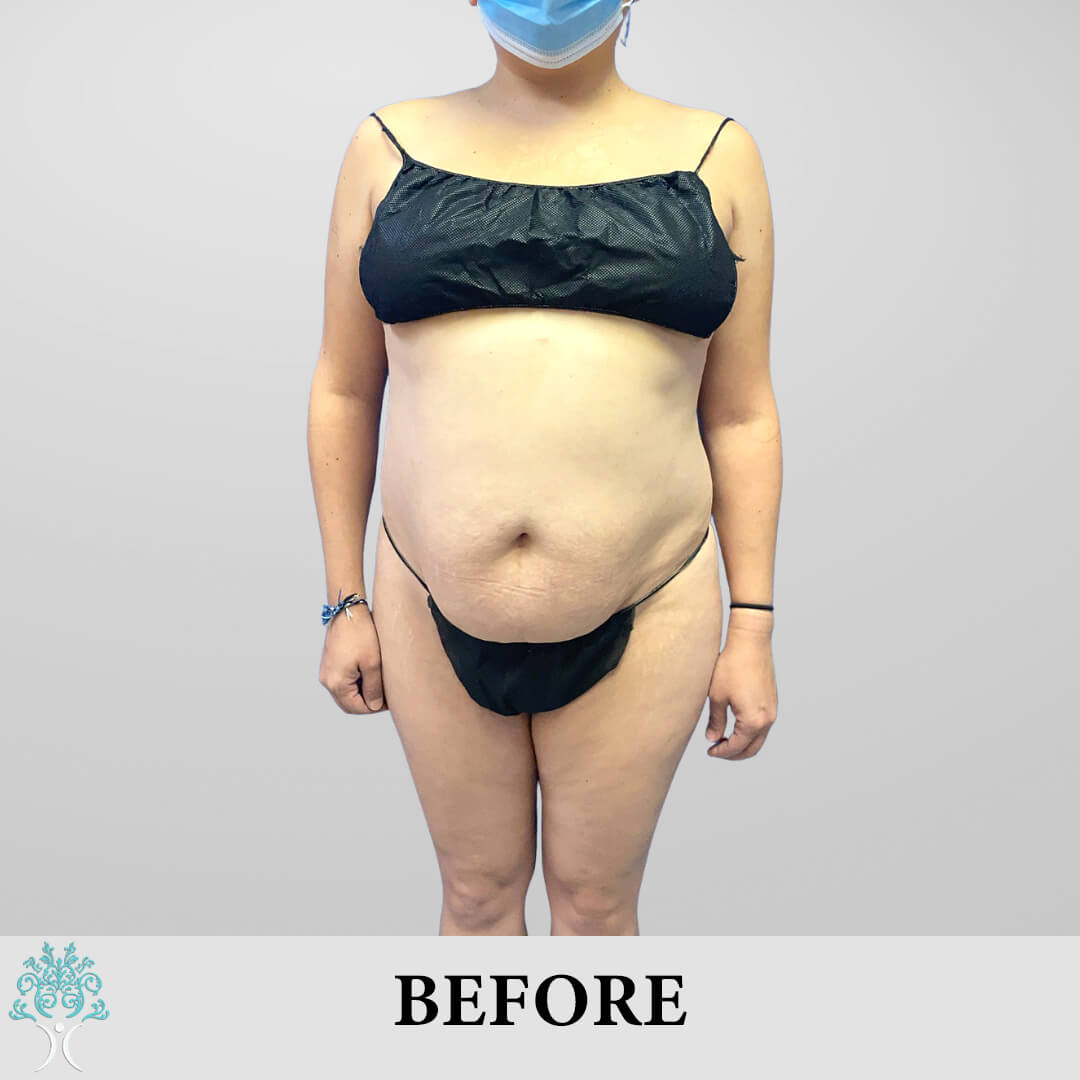 Before Lipo & Tummy Tuck