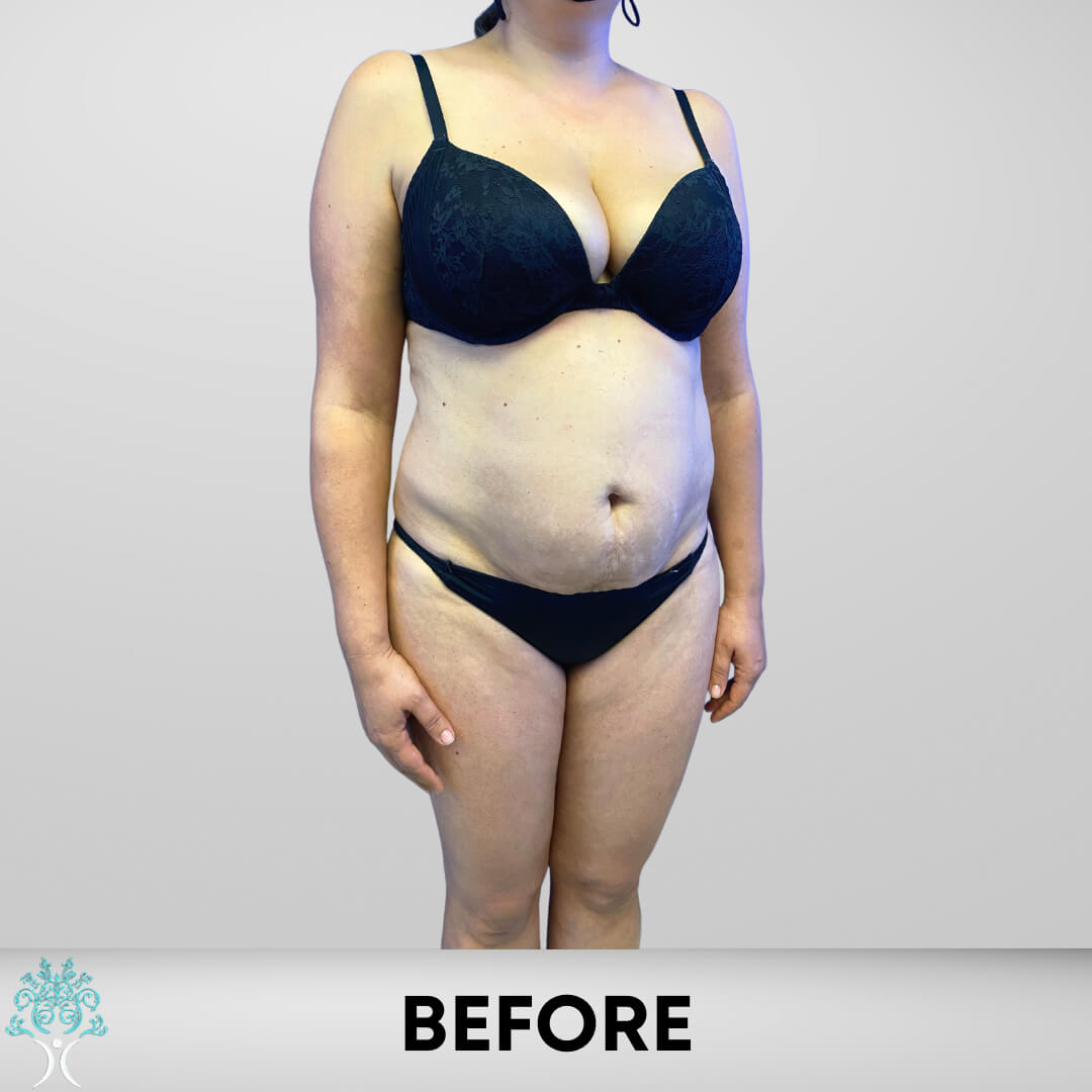 Before Lipo and Tummy Tuck